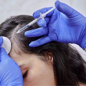 mesoterapia capilar en mujer para tratar la alopecia