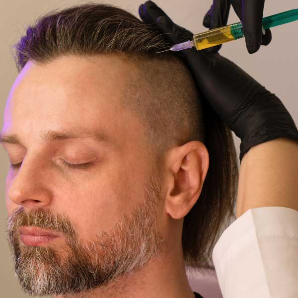 finasteride tratamiento capilar en la Clinica Capilar Velazquez en Madrid