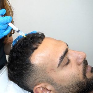 Exosomas Manuel Cortes en Clínica Capilar Velázquez