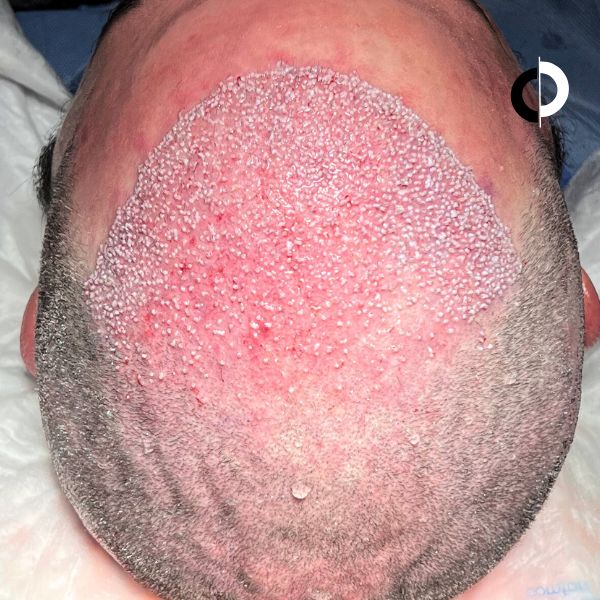 Injerto Capilar Paciente Clínica Capilar Velazquez