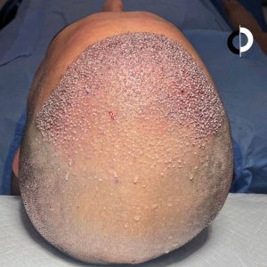 Injerto Capilar Paciente Clínica Capilar Velazquez