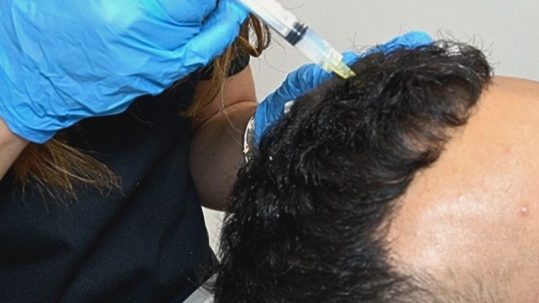 Manuel Cortes tratamiento para la alopecia en Clínica Capilar Velázquez