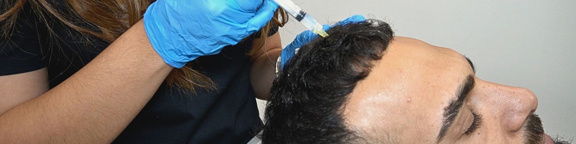 Manuel Cortes tratamiento para la alopecia en Clínica Capilar Velázquez