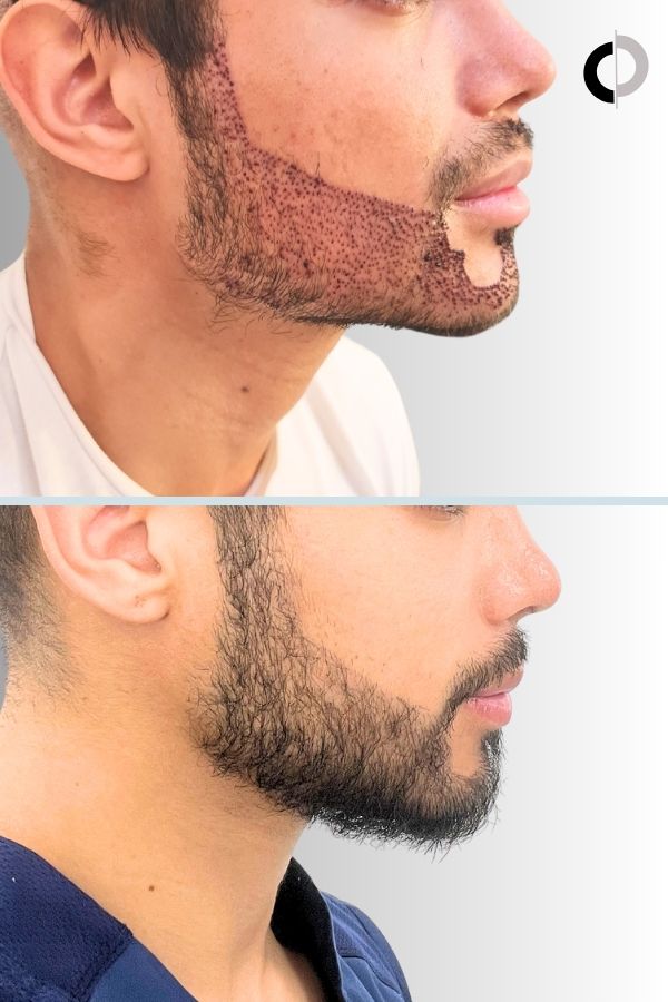 Paciente de Injerto Barba en Clínica Capilar Velázquez