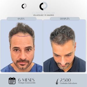 Antes y Después Injerto Capilar de 2500 unid. foliculares en Clinica Capilar Velázquez