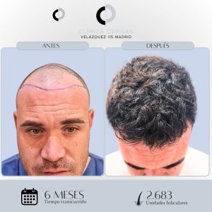 Antes y Después Injerto Capilar de 2683 unid. foliculares en Clinica Capilar Velázquez