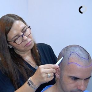 Injerto Capilar. Paciente de la Clínica Capilar Velázquez 