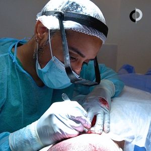 Cirugia implante capilar en Clinica Capilar Velazquez