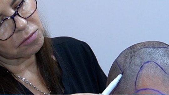 Implantes capilares Madrid en Clínica Velázquez