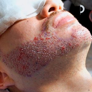 Injerto barba paciente Clínica capilar Velázquez