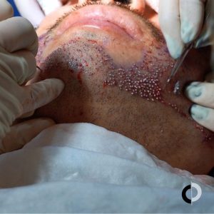 Injerto barba precio paciente Clínica capilar Velázquez