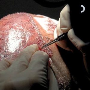 Trasplante Capilar. Paciente de la Clínica Capilar Velázquez 