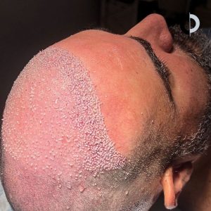 Injerto Capilar Entradas paciente Clínica Capilar Velazquez