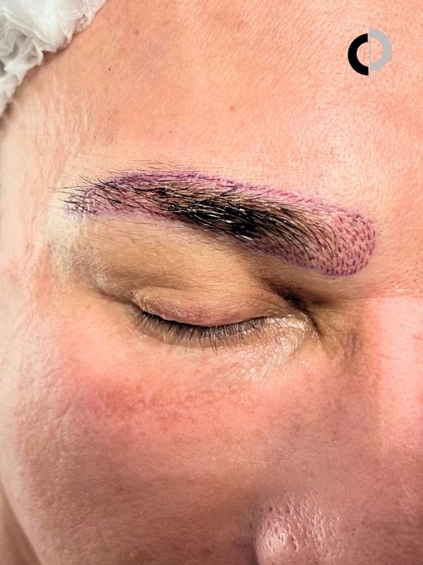Injerto de cejas paciente Clínica Capilar Velázquez