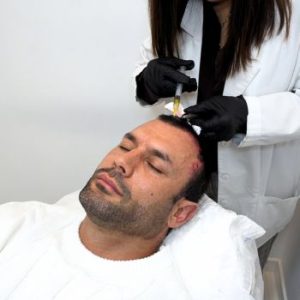 Jorge Perez tratamiento alopecia Clínica Capilar Velázquez