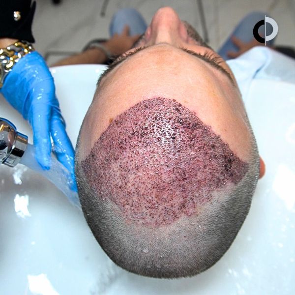 Lavado injerto capilar FUE zafiro paciente clinica capilar