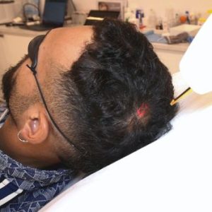 Manuel Cortes tratamiento para la alopecia en Clínica Capilar Velázquez