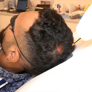 Manuel Cortes Tratamiento Láser Capilar. Paciente Clinica Velázquez. Grooming masculino