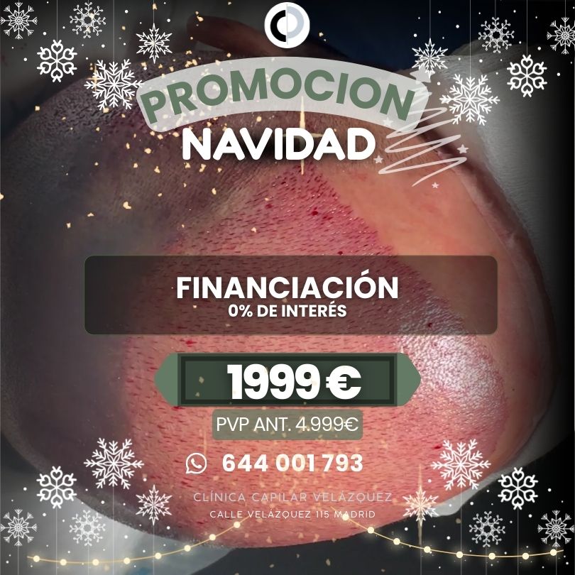 Clinica Capilar Velazquez. Injerto Capilar Madrid