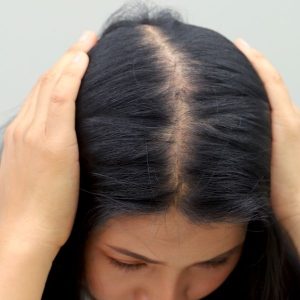 Clinica capilar mujer Madrid con mesoterapia capilares exclusivos para mujer