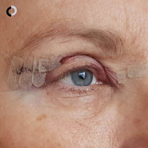 blefaroplastia antes y después de la cirugía de parpados blefaroplastia antes y después de la cirugía de parpados