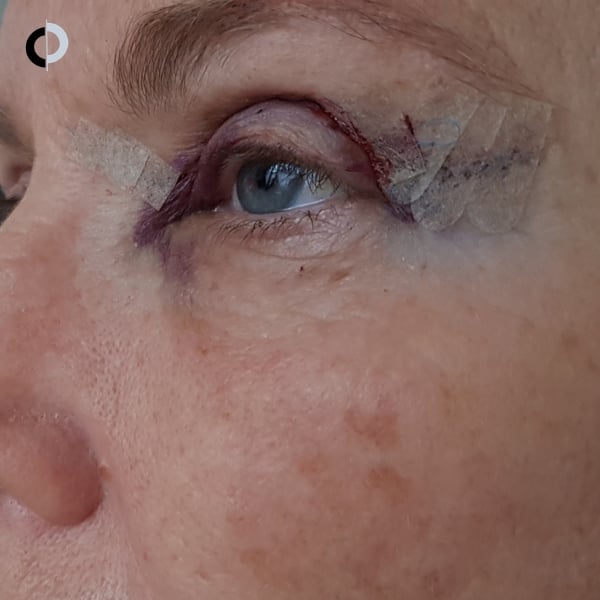 Precio Blefaroplastia en Clínica Velázquez Madrid Precio Blefaroplastia en Clínica Velázquez Madrid