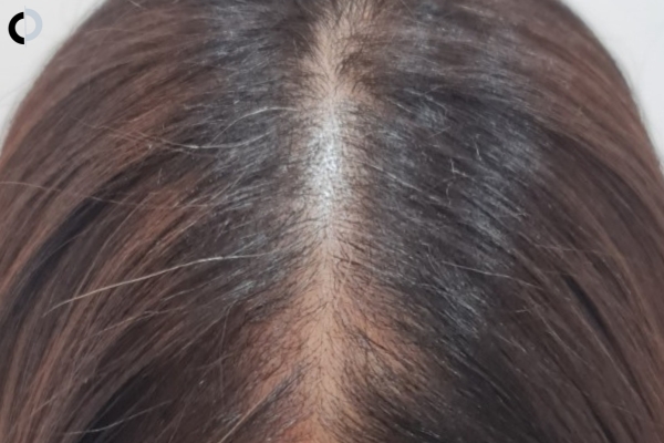 especialistas en alopecia femenina especialistas en alopecia femenina